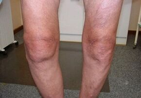 How to treat the arterry of the knee joint