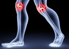 Reasons for the development of knee artosis