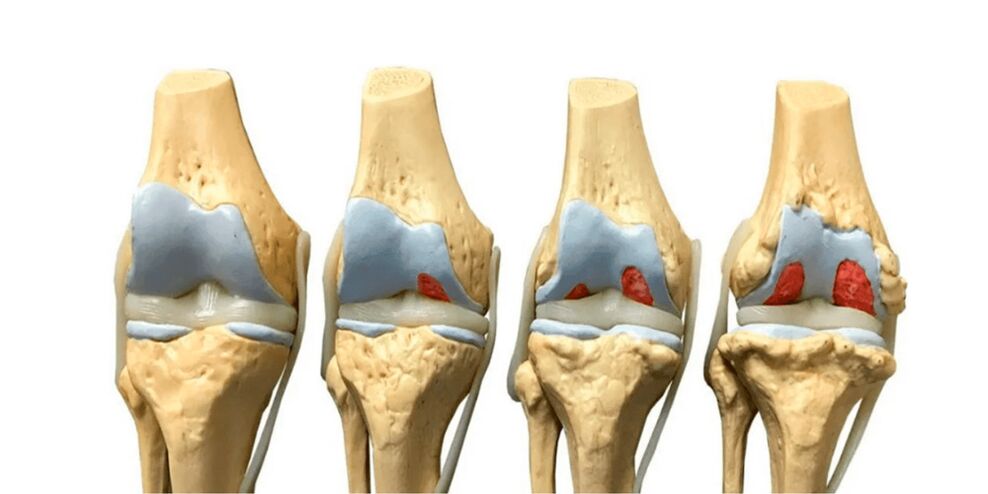 the degree of arthrosis of the joints